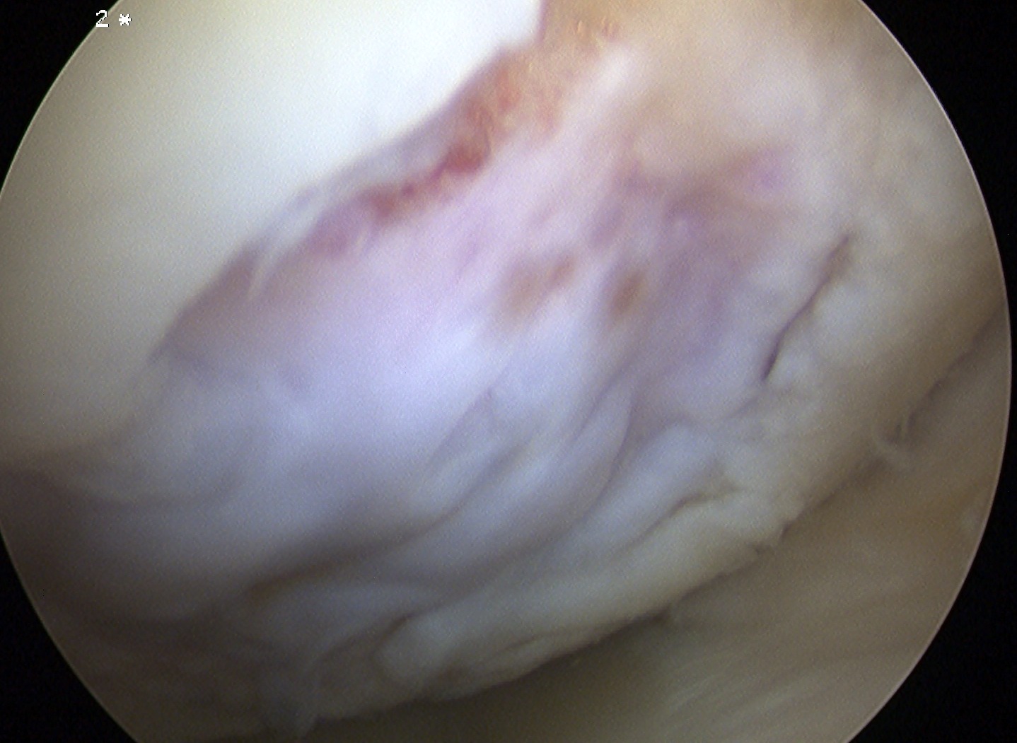 Knee OCD Arthroscopy Fully Detached